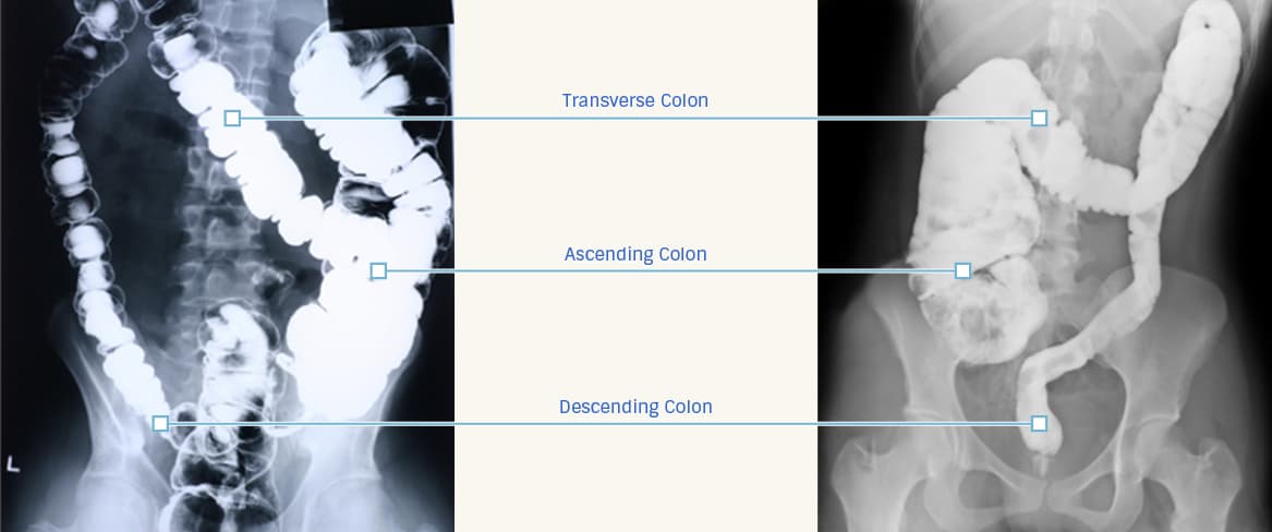an x-ray of unhealthy colons
